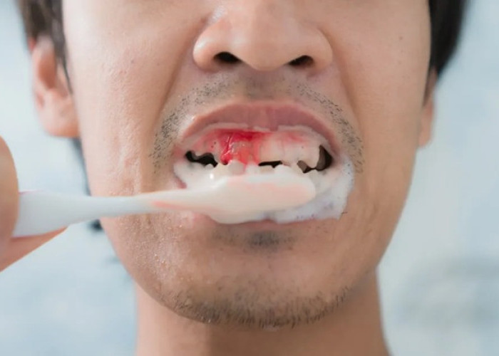Waspada Gusi Berdarah Saat Sikat Gigi: Pakar Unpad Ingatkan Risiko Penyakit Kronis