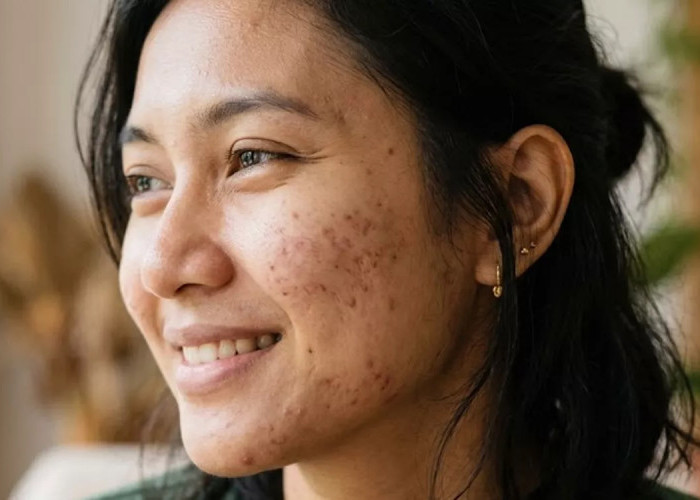 Jangan Asal Tempel! Begini Tahapan Skincare Malam agar Bekas Jerawat Cepat Pudar